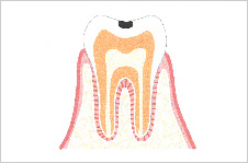 C1（エナメル質に穴が空く）